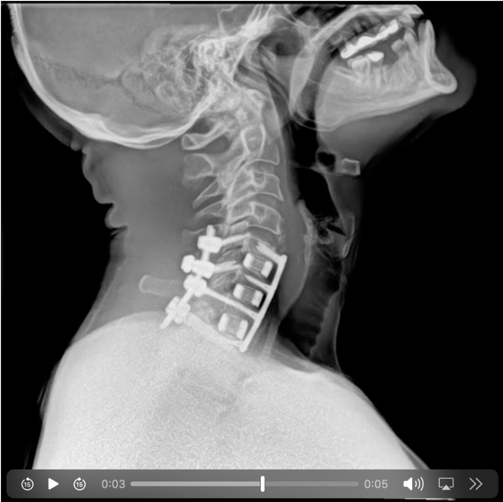 In the future, we will evaluate you with Dynamic Digital X-ray.